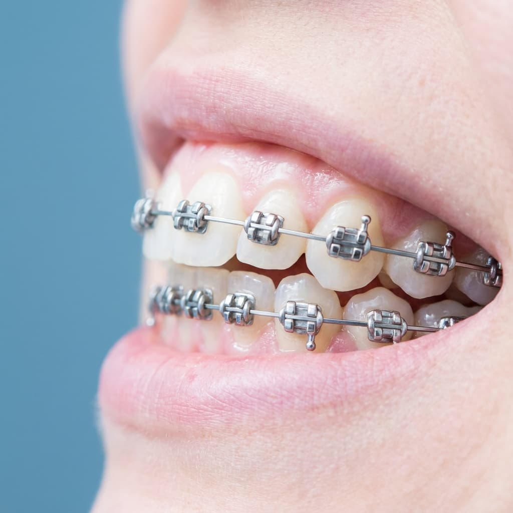 Brackets autoligado